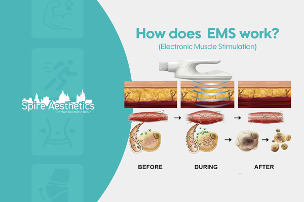 EMS treatment for post pregnancy weight loss treatment Winslow
