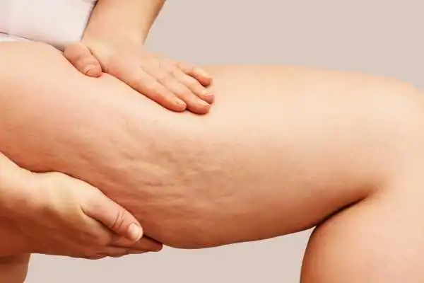 Image of woman showing leg with cellulite Winslow