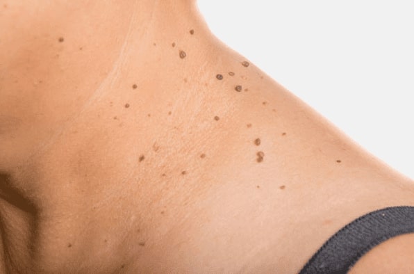 Are you looking for easy skin tag removal Winslow - then contact Spire today!
