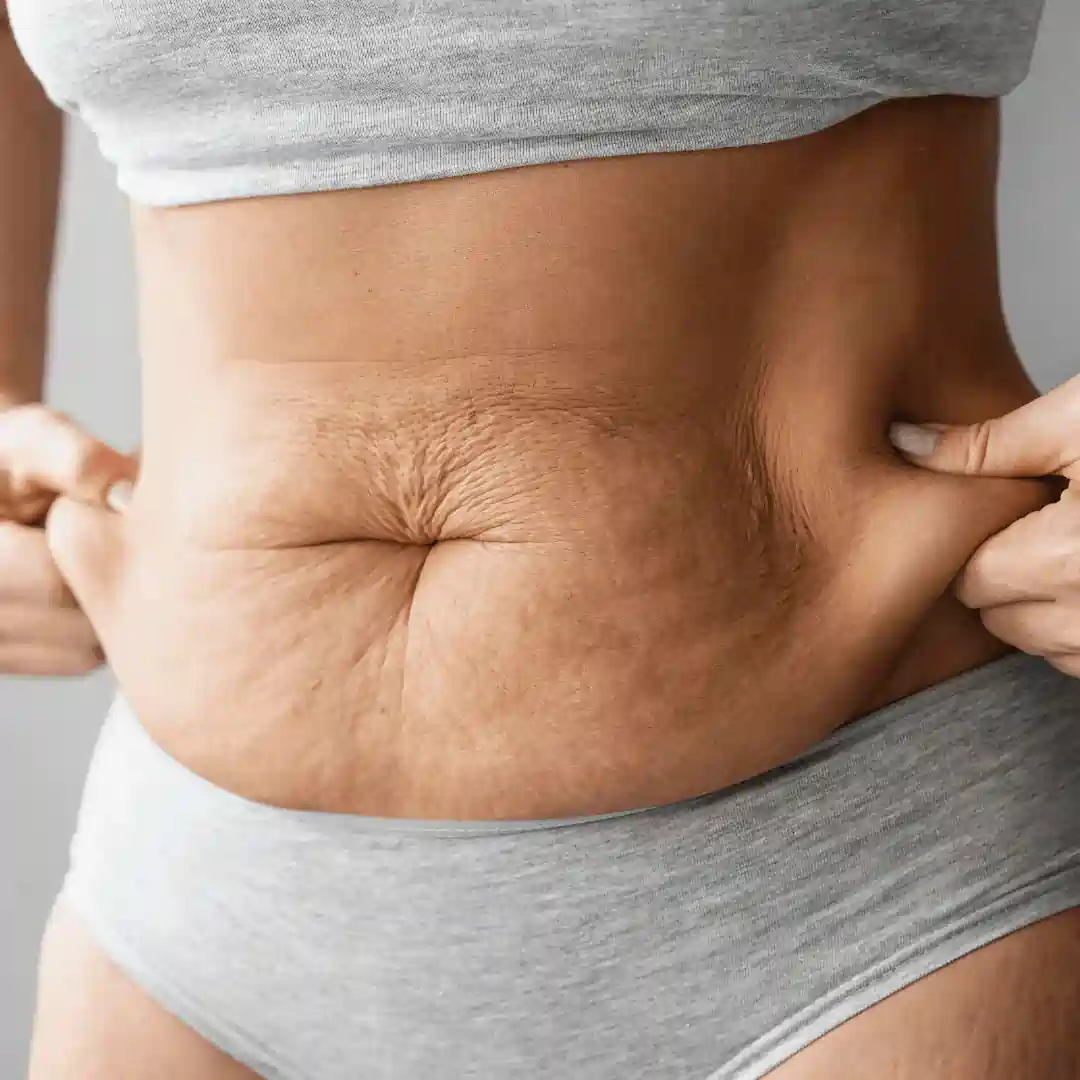 Is It Normal to Have Loose Skin After Pregnancy Winslow?